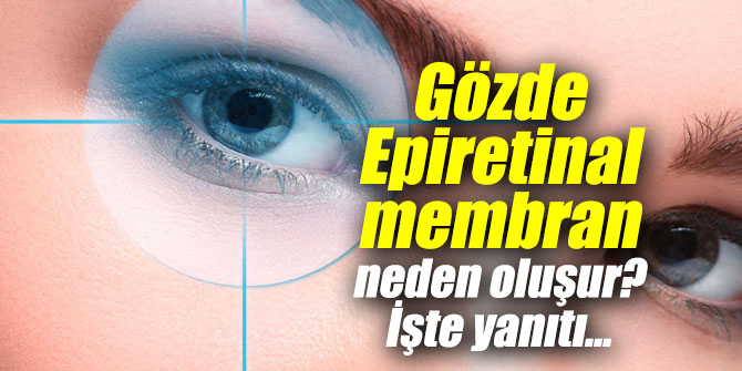 Epiretinal membran neden oluşur? İşte yanıtıKaynak: Epiretinal membran neden oluşur? İşte yanıtı…