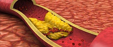Çok düşük seviyede kötü kolesterol inme riskini artırabilir
